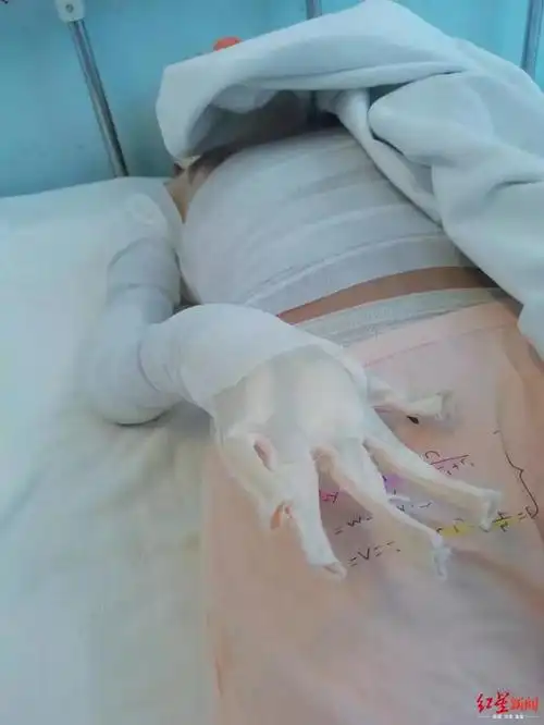 孩子的手指被烧焦了,入院治疗二十多天后,右手手指全部被截肢.