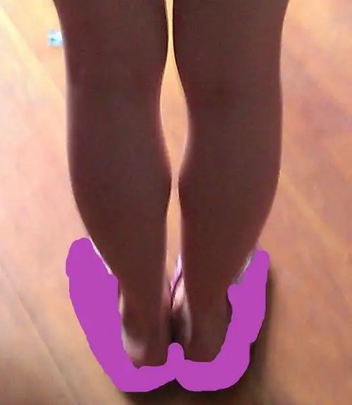 这样的小腿腿属于肌肉型,脂肪型,水肿型当中的哪一种?该怎么瘦?