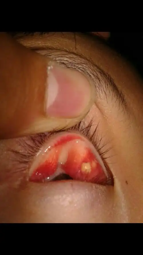 如果是的话,那就是麦粒肿,外用红霉素眼药膏,眼睛里外都要涂到,还有