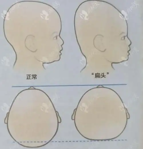 扁头与正常头型对比