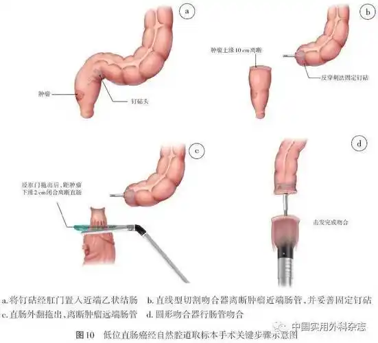 1 低位直肠癌noses消化道重建 (1) 在肿瘤近端预