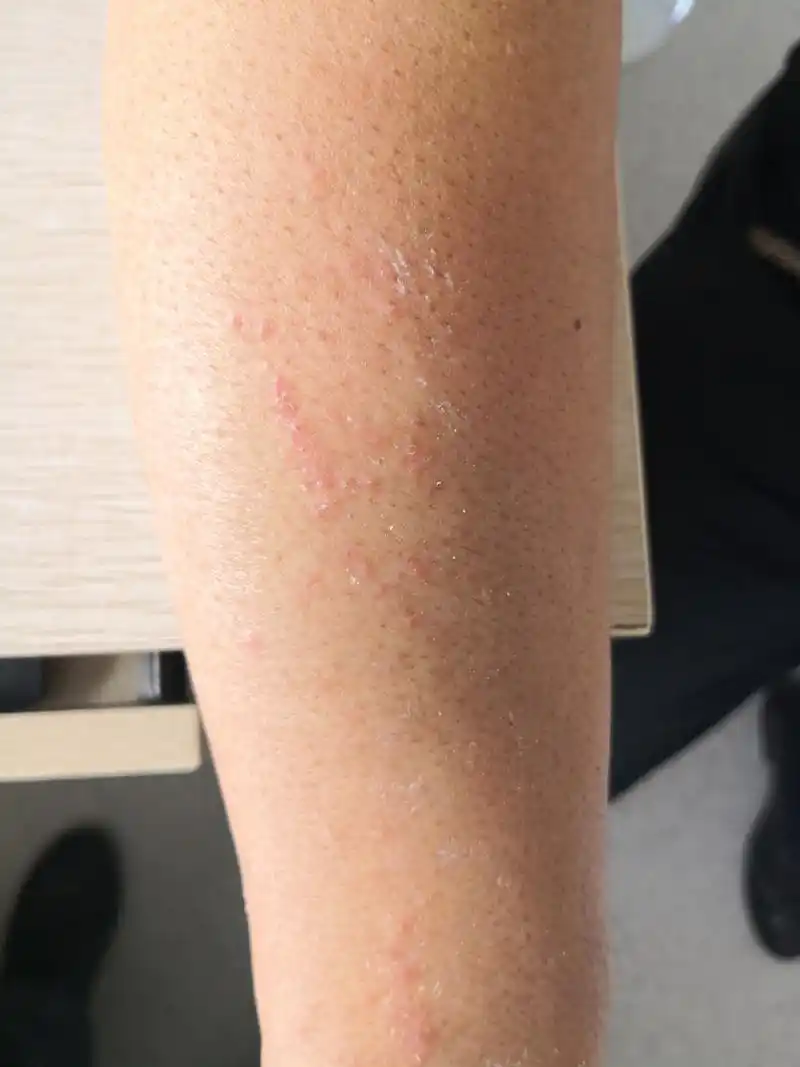 右侧前臂红斑丘疹症状,考虑夏季皮炎症状#解决皮肤问题专注皮肤美容