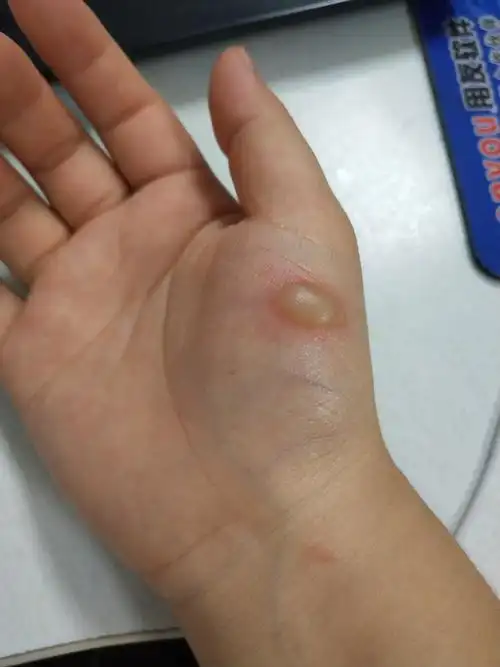 手被油烫伤起泡怎么办?需要挑破吗?