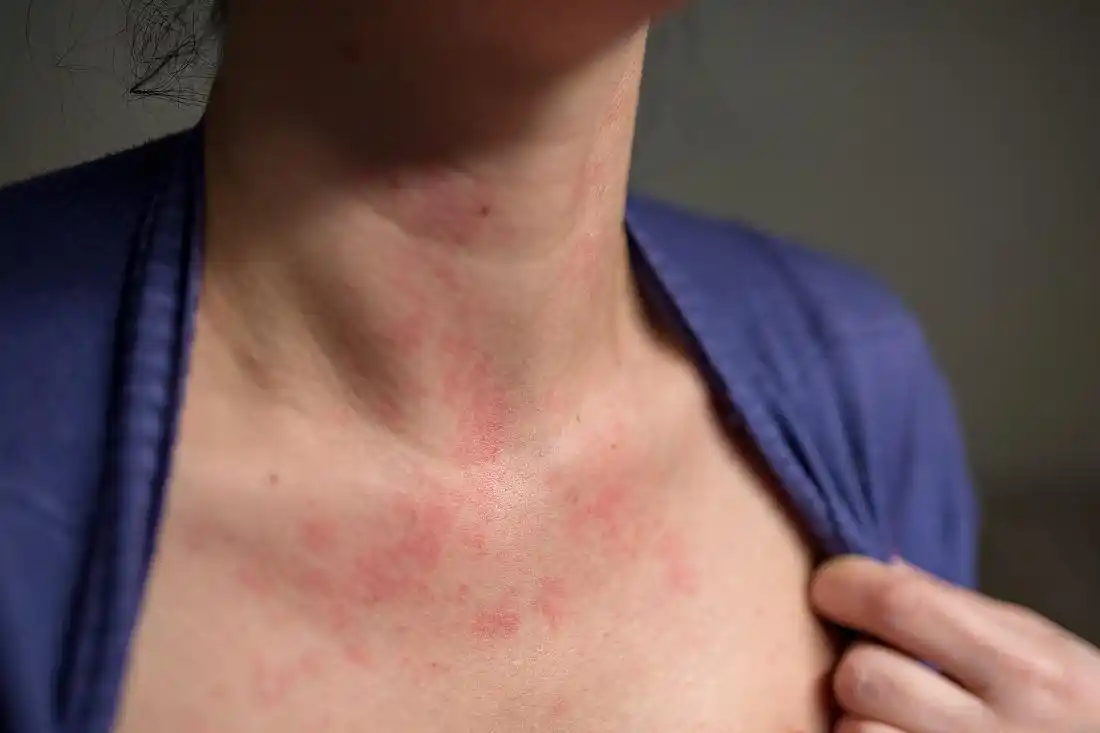 别把艾滋病和皮肤病混淆了!皮肤出现3种异常,要多提高警惕