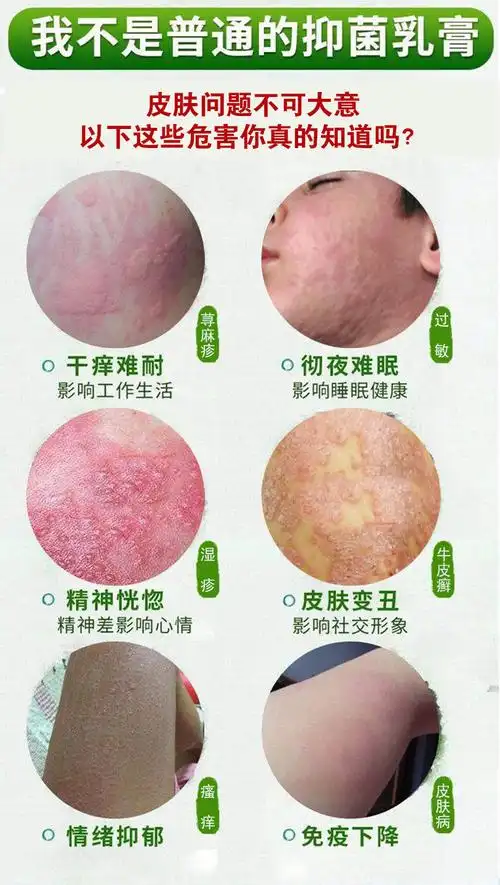 紫椒癣町酊牛皮l癣银l屑病头皮l癣手紫椒癣町酊牛头虎毒共发5盒巩固