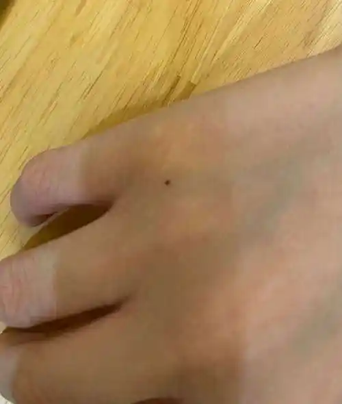 为什么会生痣 左手为什么会长痣