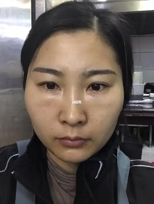 玻尿酸填充泪沟第9天