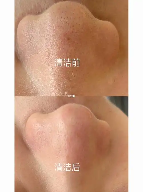 深层清洁//宁波皮肤管理