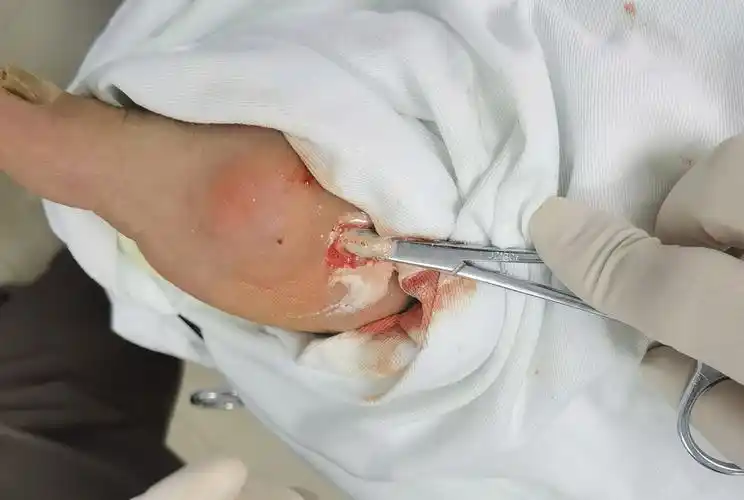 术中流出的白色尿酸盐结晶术中清除出来的痛风石手术结束手术非常顺利