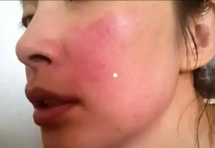 脸皮肤发红过敏怎么办3招皮肤胜过董晴