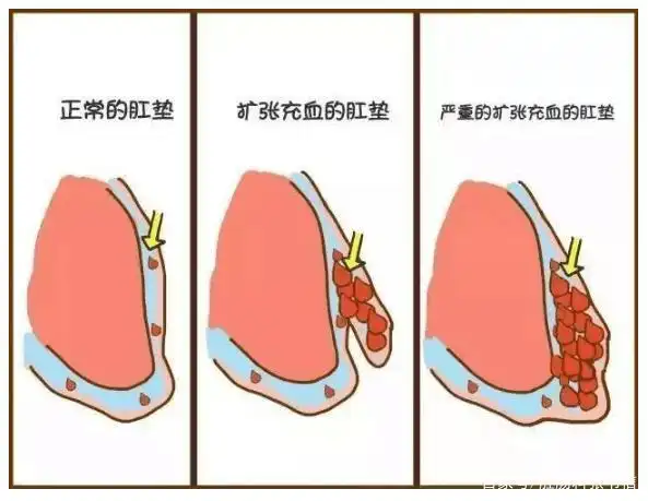痔疮手术并非一定要做,但这些情况还需特别注意!