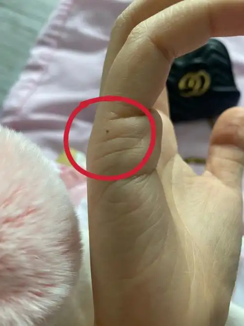 什么癌症了怎么会有痣突然冒出来呢我真的很不理解哭哭#黑痣今天去医