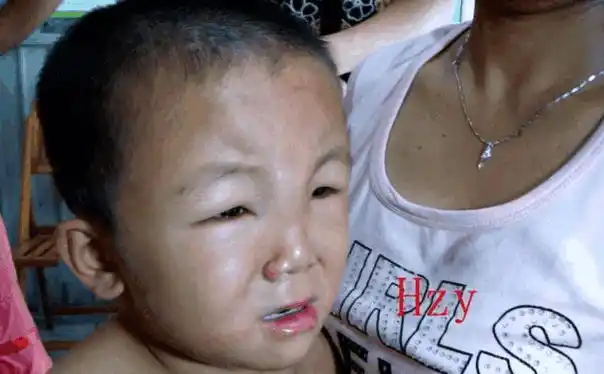 终成肾脏衰竭家长痛哭流涕|肾病综合征|浮肿|眼皮_新浪新闻