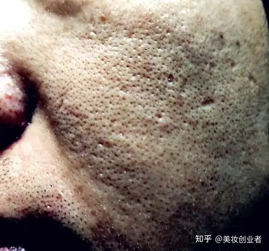 毛孔粗大形成的黑洞该如何护肤