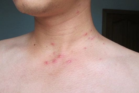 梅毒二期症状 (39)