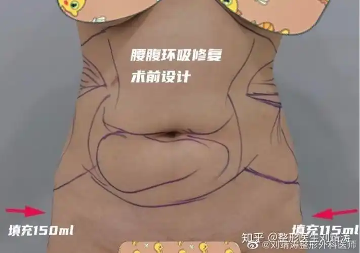 腰腹环吸手术的折角腰