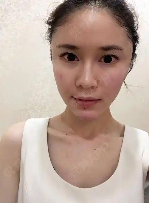 自体脂肪面部填充术后3天_面部填充术后3天_自体脂肪术后3天_面部轮廓