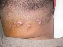 项部硬结性毛囊炎