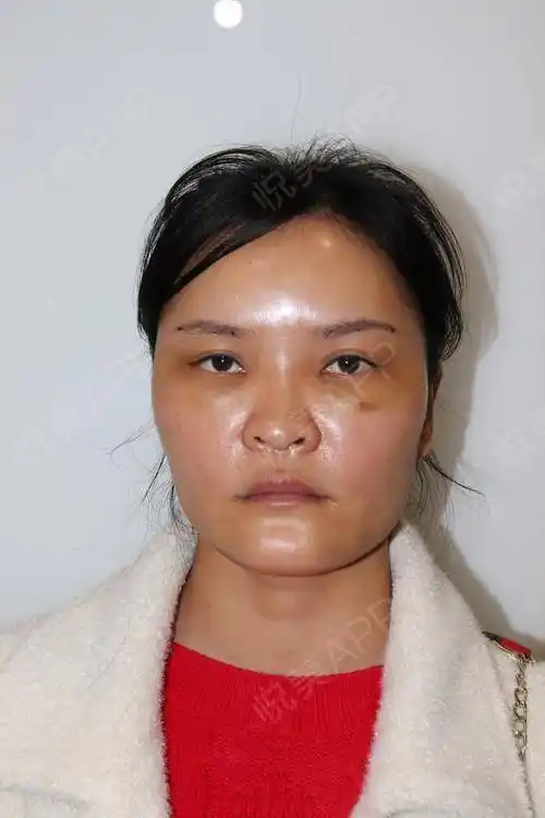 现在第七天了,额头填得比较饱满,加上好几天没洗脸了,油亮油亮的,油得