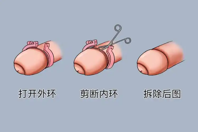 商环手术后环脱落过程图片