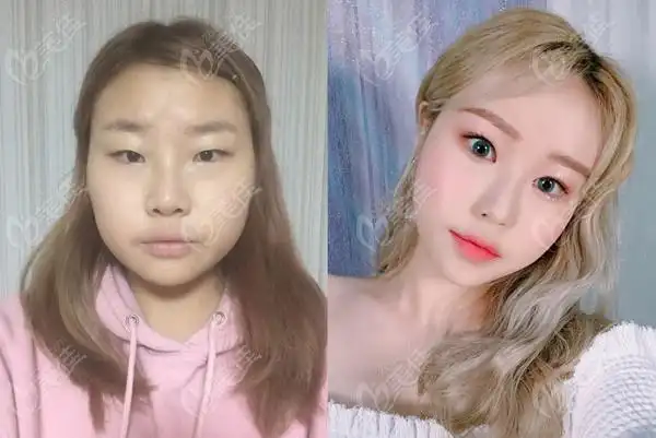 手术方案:全脸脂肪填充 眼综合(切开双眼皮 开内眼角 去皮去脂)起因是