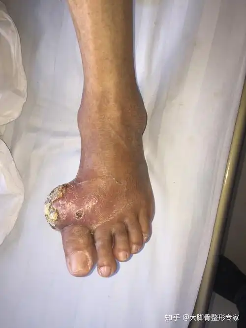 大脚骨手术真案例湖南女孩拇外翻手术