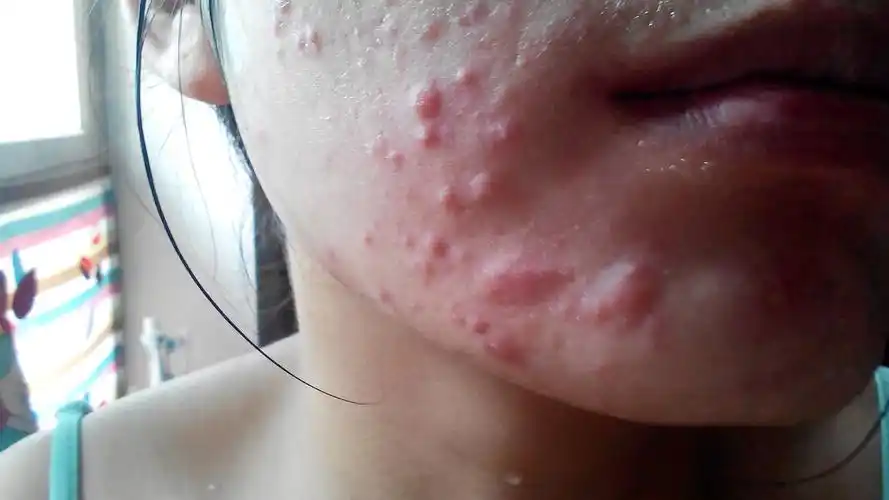 开始有逗没这么严重也不痒,后来吃虾这,回来就痒的难受,早晨起来还有