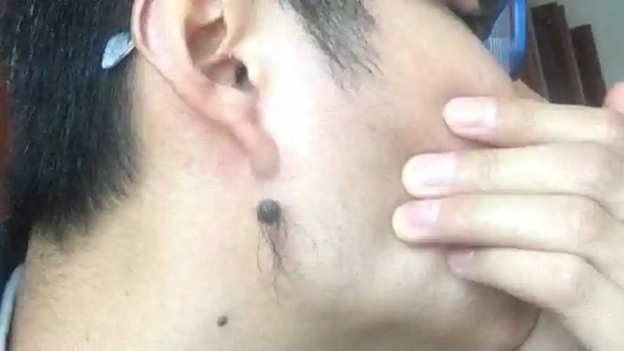 痣上长毛是好是好坏算命大师道明真相早知早好