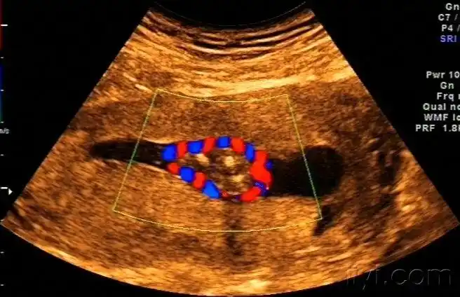看这个宝宝的脐带绕颈多经典! - 超声医学讨论版 - 爱爱医医学论坛