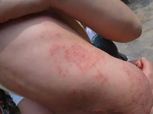 疥疮结节图片 (7)