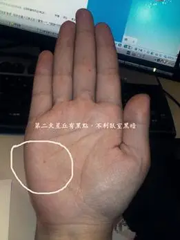 凶痣点掉了运势会好吗_中指有痣好吗_艺美轩