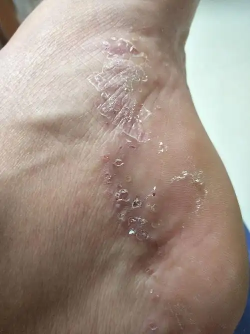 脚上老是长这么多小水泡咋整啊?痒痒痒的难受!