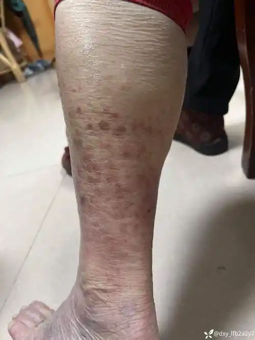 老人75岁皮肤瘙痒多年诊断