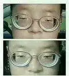 高度近视后,我甚至想到过死!你还在消费你的眼睛吗?