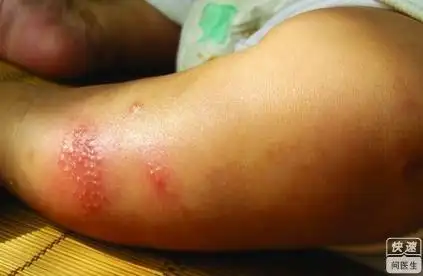 疥疮的治疗方法有哪些呢?