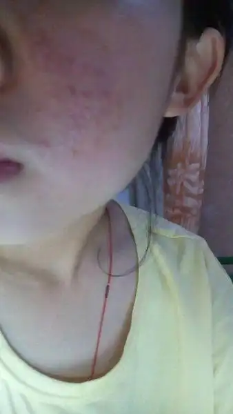 由于化妆品导致的过敏,症状减轻后脸颊一侧粉刺很多,消不掉,我才16.