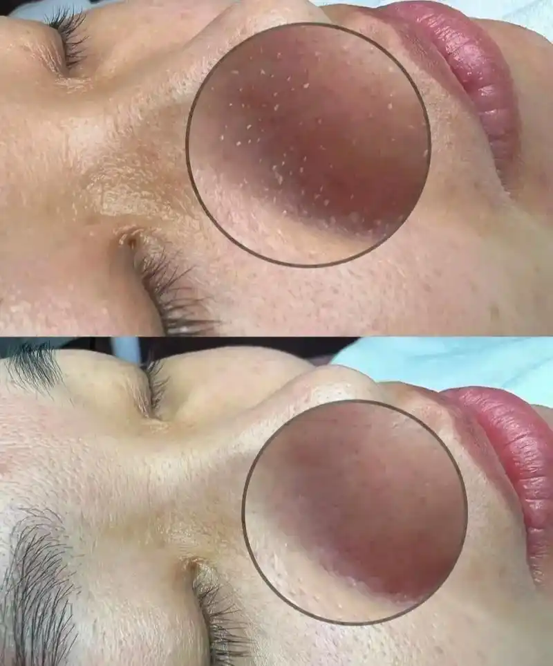 毛囊清洁术对比90.