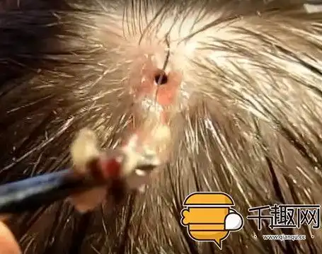 男子头上竟寄生了一直大蛆虫!慎入,小心会吐!