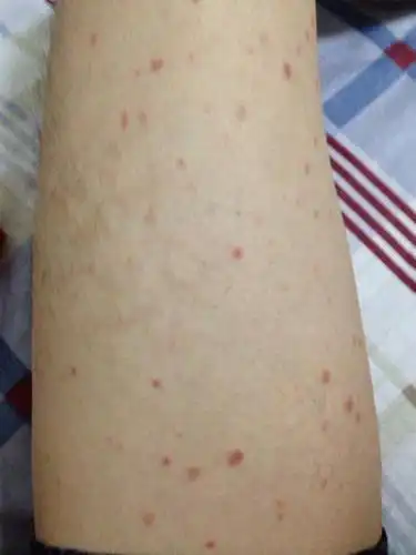 我的背上,手上,大腿,肚子,都长了这样的小红点,是怎么回事?