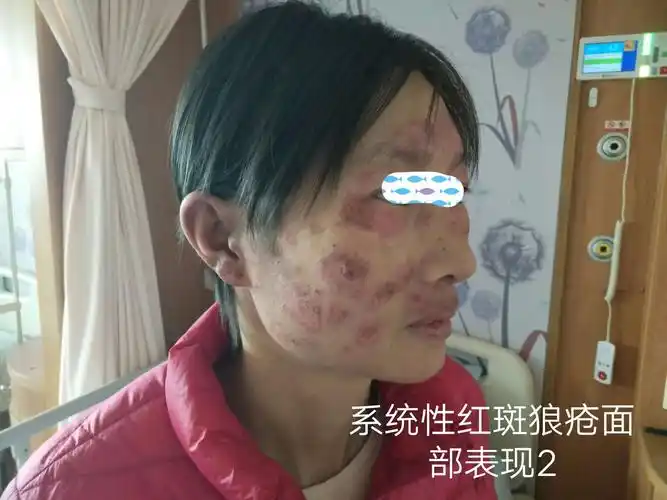 系统性红斑狼疮面部表现