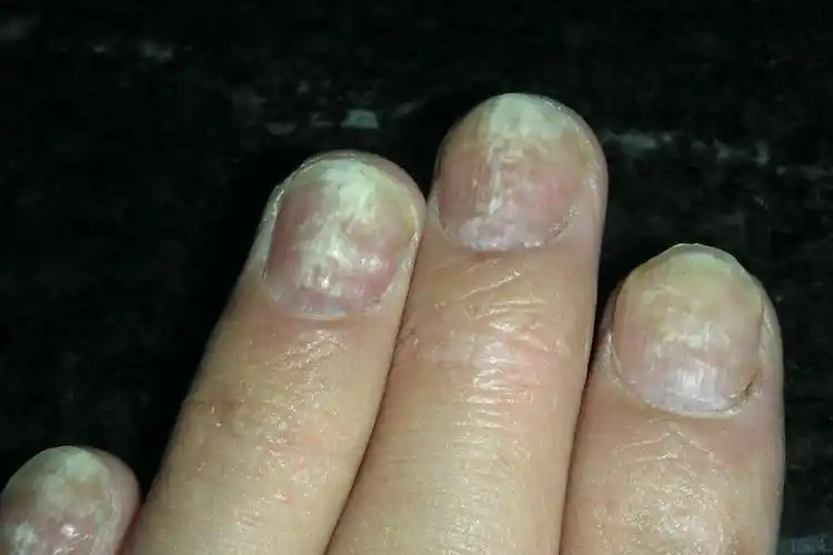 白色浅表型灰指甲图