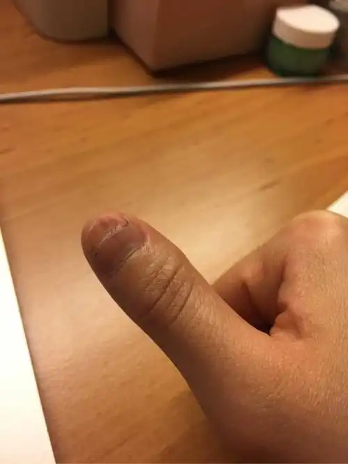 现在甲根部淤血散到半个指甲.肿痛了24小时了,多久才消肿?