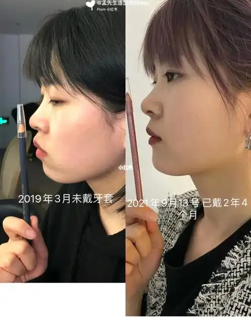 戴牙套前后对比