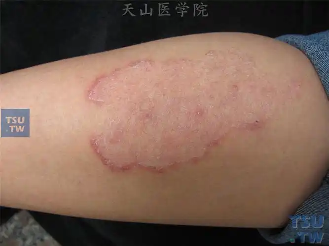 【附图】 体癣(tinea corporis)的症状表现 _皮肤病诊断图谱 | 天山
