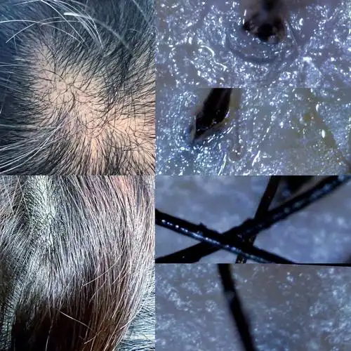 全87油性头皮究竟是什么样63