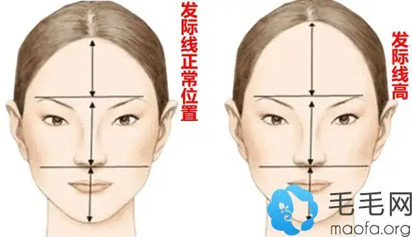 发际线正常位置和女性标准的发际线图片