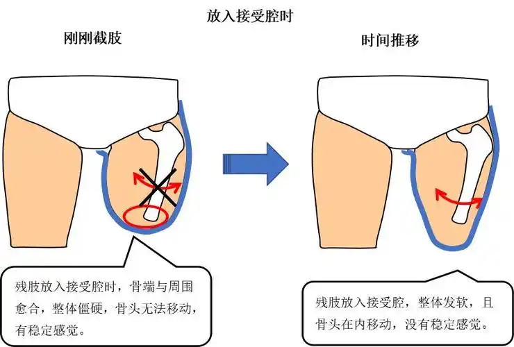 接受腔系列专栏三日本资深假肢技师接受腔舒适度的影响因素