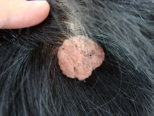 典型病例——软纤维瘤