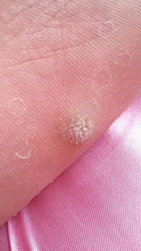 这是鸡眼吗,我贴了次鸡眼膏,拔出来一个硬的小的东西,以为会好,过几天