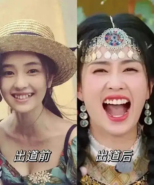 明星都爱烤瓷牙原因牙龈萎缩真的不能在修复?中医表示不认同!